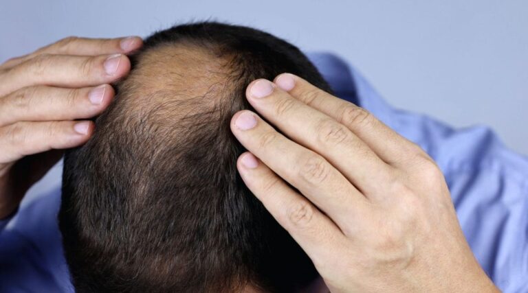 What are the causes of failed FUE hair transplants?